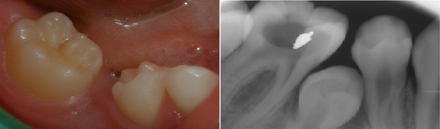 Erken Diş Kayıplarında Önlem Alınmazsa Oluşabilecek Sorunlar